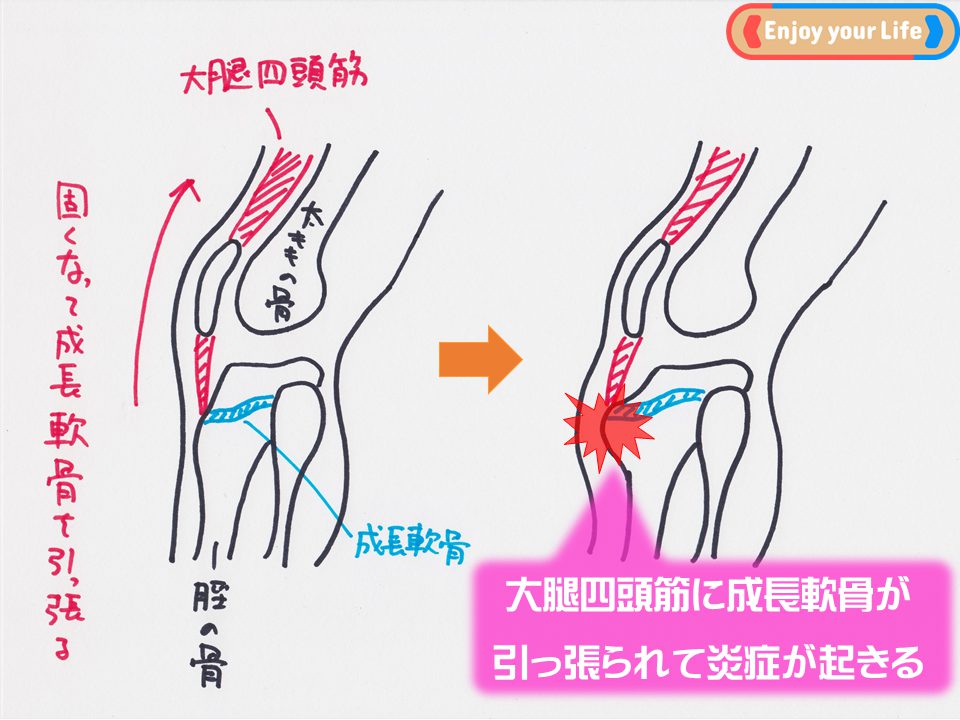 膝の下が痛い 成長期に見られるオスグッドの原因と改善方法 思い通りに動ける身体作り専門トレーナー村松佑一のofficial Website